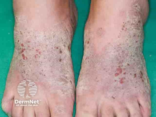 A Dermatite de Contato pode ser provocada por materiais presentes nos calçados, como couro, borracha, cola ou corantes. As lesões costumam aparecer nos pés, causando vermelhidão, coceira e descamação nas áreas de contato.