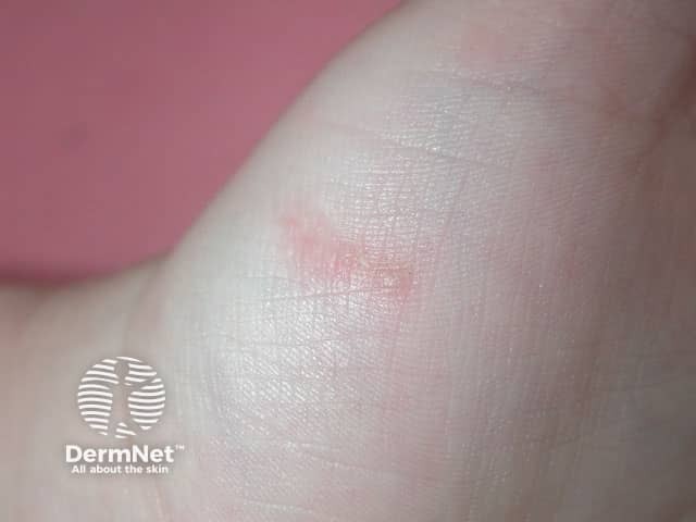 Um sinal típico da escabiose são os pequenos túneis feitos pelo ácaro logo abaixo da camada mais superficial da pele. Eles aparecem como linhas finas e discretas, onde a fêmea deposita seus ovos.