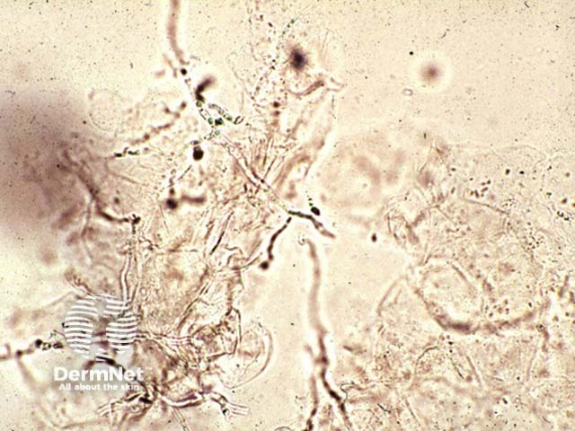 O exame micológico direto é um dos principais exames para confirmar a micose de pele. Uma pequena amostra da descamação é analisada ao microscópio para verificar a presença de fungos.