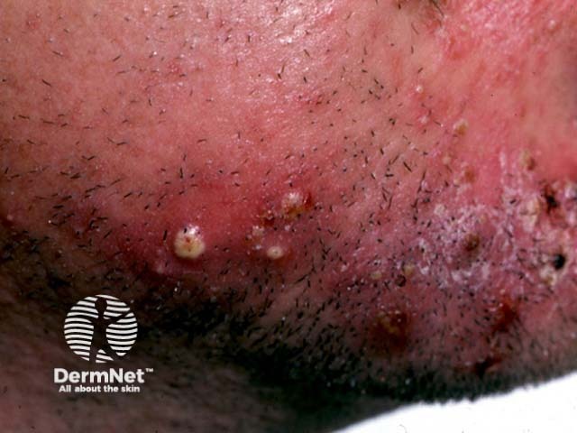A micose de pele pode atingir a região da barba, recebendo o nome de tinha barbae. Ela costuma causar placas avermelhadas, descamação, inflamação e, em alguns casos, queda dos pelos da barba.
