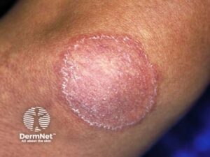 A tinha corporis é uma micose de pele que pode surgir em qualquer região do corpo. As lesões geralmente têm formato arredondado, bordas avermelhadas e descamativas, com tendência ao crescimento gradual.