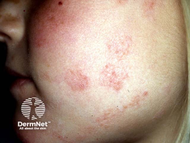 A tinha faciei é a micose de pele que acomete o rosto. As manchas podem ser avermelhadas, descamativas e, muitas vezes, são confundidas com alergias ou outras doenças dermatológicas.
