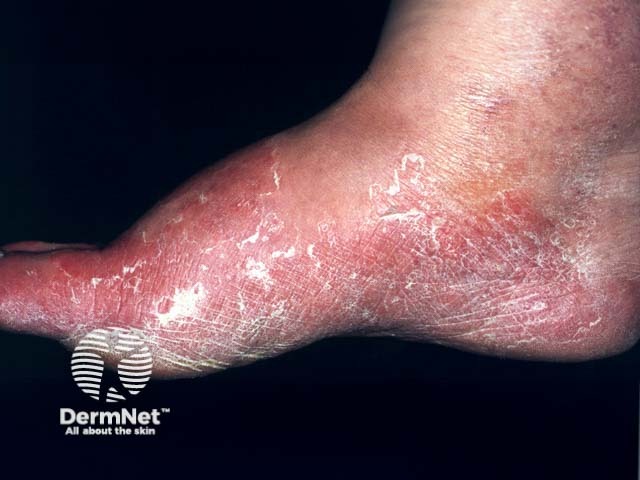 A tinha pedis é um tipo de micose de pele que acomete os pés, sendo popularmente conhecida como "frieira". Ela costuma causar coceira, descamação, rachaduras e vermelhidão, principalmente entre os dedos dos pés, onde a umidade favorece o crescimento dos fungos.