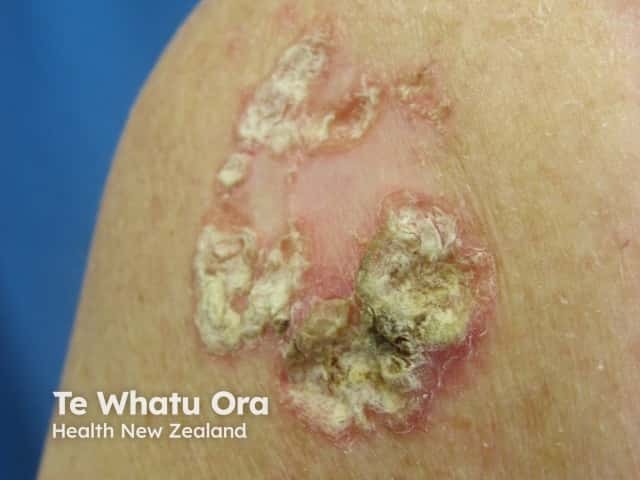 O Carcinoma Basocelular do subtipo basoescamoso é uma forma menos comum e pode apresentar comportamento mais agressivo do que outros subtipos. Por isso, o diagnóstico e o tratamento precoces são especialmente importantes.