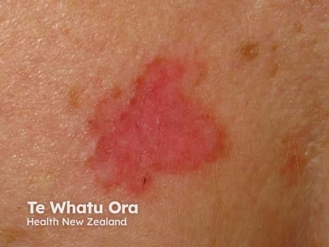 O Carcinoma Basocelular superficial costuma aparecer como uma placa avermelhada, fina e levemente descamativa. É mais frequente no tronco e pode ser confundido com eczema ou outras doenças da pele.