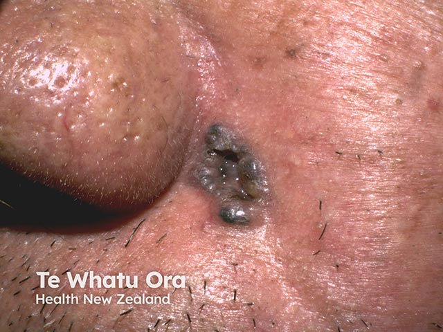 O Carcinoma Basocelular pigmentado contém maior quantidade de melanina e pode apresentar coloração marrom, azulada ou enegrecida. Em alguns casos, pode ser confundido com um melanoma, exigindo avaliação especializada.