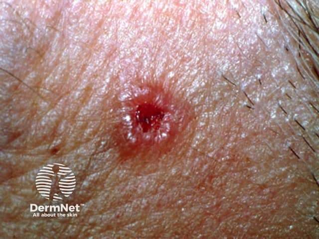 Uma característica clássica do Carcinoma Basocelular é a presença de bordas elevadas e brilhantes, chamadas de bordas cilíndricas ou peroladas. Esse aspecto ajuda o dermatologista a suspeitar do diagnóstico durante o exame da pele.