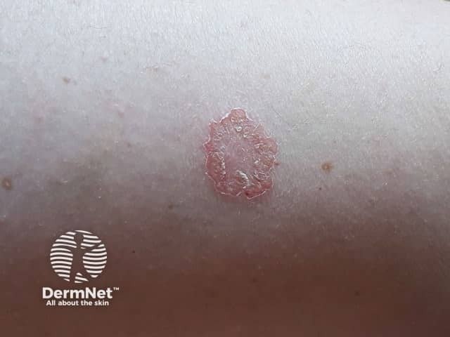 A dermatite numular costuma provocar lesões arredondadas ou ovais na pele, lembrando o formato de uma moeda. Elas podem ser avermelhadas, descamativas e causar bastante coceira.