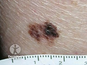 O tipo que os médicos mais encontram nos consultórios é o melanoma extensivo superficial. Ele costuma começar como uma mancha plana, de bordas tortas, que vai "espalhando" para os lados na pele durante um bom tempo antes de crescer para o fundo. Nas mulheres, aparece muito nas pernas, e nos homens, nas costas.