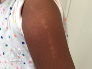 Uma das características mais curiosas do líquen estriado é o seu formato. Em vez de formar manchas redondas ou espalhadas pelo corpo, ele aparece como uma linha contínua, semelhante a um "risco" ou uma fita na pele. Isso acontece porque a condição segue caminhos invisíveis que já existem no nosso corpo desde quando ainda estávamos na barriga da nossa mãe. O resultado é esse desenho comprido e reto, que costuma surgir principalmente em um dos braços ou em uma das pernas.