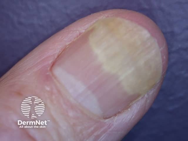 A onicólise associada à Síndrome das Unhas Frágeis pode ser percebida como uma área branca ou esbranquiçada na parte final da unha. O uso frequente de produtos químicos e traumas podem favorecer esse descolamento.
