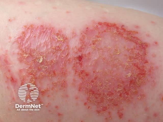 Em alguns casos de dermatite numular, podem surgir crostas fibrinosas sobre as lesões. Elas aparecem principalmente quando existe maior inflamação e saída de líquido pela pele.