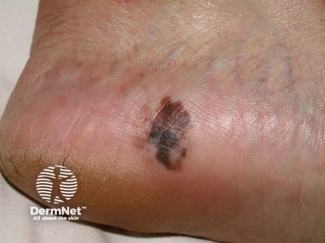 Muita gente acha que o câncer de pele só dá onde bate sol, mas o melanoma acral prova o contrário. Esse tipo aparece na palma das mãos e na sola dos pés, sendo a forma mais comum da doença em pessoas de pele negra, parda ou asiática.