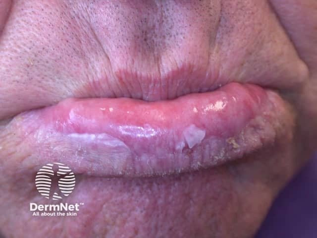 É preciso ter muita atenção e buscar um dermatologista, pois o maior risco desse tipo de queilite causada pelo sol é a sua capacidade de evoluir para um câncer de pele. Quando as feridas nos lábios não cicatrizam de jeito nenhum, sangram com facilidade e a descamação se torna persistente, é um sinal de alerta de que as células estão sofrendo alterações malignas perigosas.
