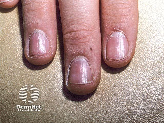 A Síndrome das Unhas Frágeis também pode apresentar traquioníquia, caracterizada por unhas ásperas, opacas e com várias pequenas linhas e irregularidades. A superfície pode ficar com aspecto semelhante a uma lixa.