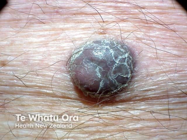 O melanoma nodular é o tipo mais "apressado" e agressivo da doença. Em vez de crescer para os lados como uma mancha, ele rapidamente forma um carocinho (um nódulo) escuro, azulado ou avermelhado, crescendo direto para as camadas mais profundas da pele.