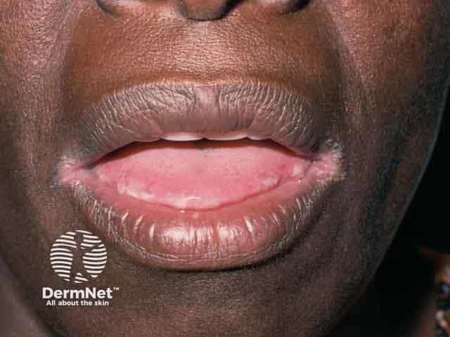 As causas da queilite angular estão frequentemente ligadas ao acúmulo de saliva na região, o que cria um ambiente úmido perfeito para a multiplicação de fungos e bactérias. O uso de próteses dentárias (dentaduras) mal ajustadas, o hábito constante de lamber os lábios e até a falta de vitaminas e ferro no corpo favorecem o aparecimento dessas rachaduras.