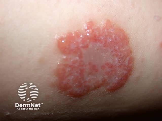 A dermatite numular pode apresentar lesões exsudativas, ou seja, áreas que liberam um líquido claro ou amarelado. Quando isso acontece, é comum a formação de crostas sobre a superfície da pele.
