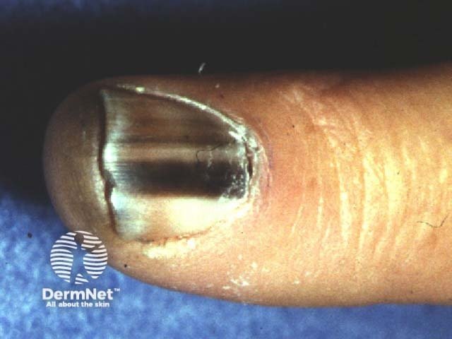 Um subtipo que exige atenção é o melanoma subungueal. Ele surge debaixo da unha, do pé ou da mão, e muitas vezes se parece com uma listra ou mancha escura na unha que não some de jeito nenhum e vai ficando mais larga com o passar do tempo.