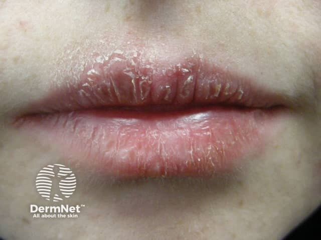 Muitas vezes, sem perceber, criamos o hábito ansioso de passar a língua, lamber ou morder a boca constantemente, o que acaba provocando a queilite esfoliativa. Como a nossa saliva possui enzimas digestivas feitas para quebrar alimentos, ela acaba agredindo a pele fina dos lábios, criando um ciclo vicioso: a boca resseca, a pessoa lambe para tentar umedecer, e isso piora a inflamação, gerando casquinhas grossas e rachaduras que nunca saram.