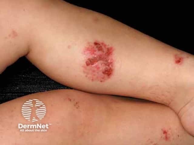 A dermatite numular é relativamente comum em pessoas que também apresentam dermatite atópica. Nessas situações, a pele costuma ser mais seca e sensível, favorecendo o aparecimento das lesões.
