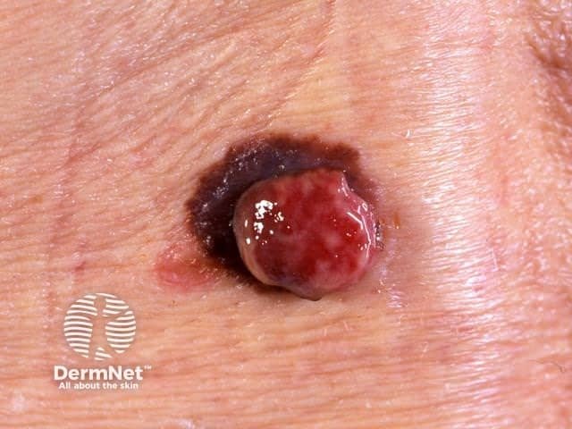 O melanoma nodular é o tipo mais "apressado" e agressivo da doença. Em vez de crescer para os lados como uma mancha, ele rapidamente forma um carocinho (um nódulo) escuro, azulado ou avermelhado, crescendo direto para as camadas mais profundas da pele.