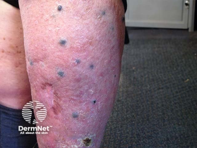 Se a doença não for tratada no início e as raízes atingirem os vasos sanguíneos, as células doentes podem viajar para outros órgãos do corpo (como pulmões ou fígado), o que chamamos de melanoma metastático. Nessa fase mais grave, o tratamento usa medicamentos modernos, como a imunoterapia, para ensinar o corpo a combater a doença.