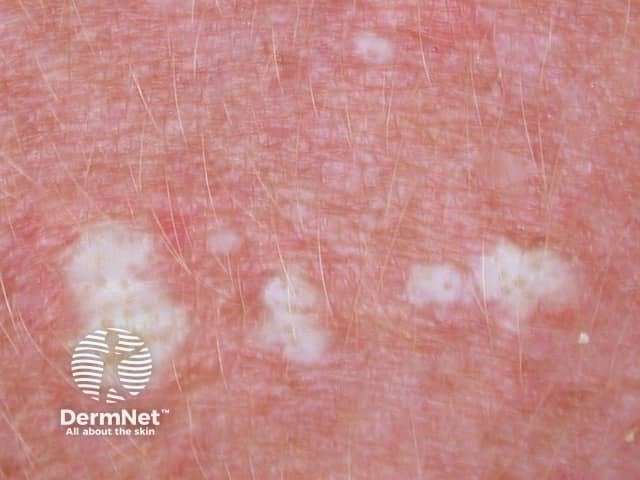 Por surgir de repente, o líquen estriado pode assustar os pais quando aparece em crianças. No entanto, o dermatologista consegue identificá-lo no consultório.