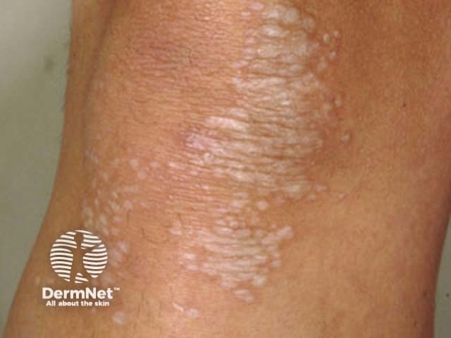 Embora muitas vezes não cause dor, o líquen estriado pode provocar uma coceira desconfortável na região afetada. Ele é caracterizado pelo surigmento de manchas esbranquiçadas, que podem apresentar um aspecto fino ou enrugado, semelhante a papel de seda.