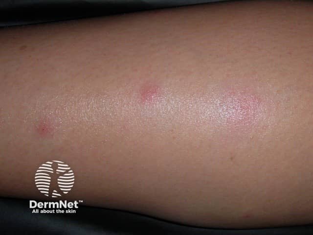 Um sinal muito clássico da presença do percevejo de cama é a forma como ele pica a pele. É muito comum notar três picadas avermelhadas alinhadas ou muito próximas umas das outras, um padrão popularmente chamado de "café da manhã, almoço e jantar". Isso acontece porque o inseto costuma andar um pouco e picar a pele várias vezes seguidas durante a mesma refeição.