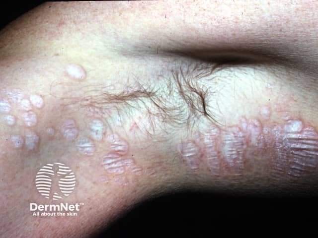 Conforme a condição se desenvolve, as bolinhas acompanham as linhas naturais da pele, parecendo uma marca contínua. Observar se há bordas eritematosas ajuda o médico a identificar o nível de inflamação e a diferenciar essa mancha de outras doenças de pele parecidas.