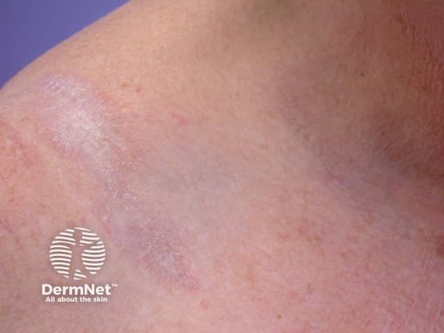 Na maioria dos casos, o líquen estriado desaparece sozinho com o tempo sem deixar cicatrizes graves. O uso de pomadas específicas ajuda a acalmar a pele, reduzindo a coceira e suavizando o tom vermelho das bordas eritematosas até que a pele volte ao normal.